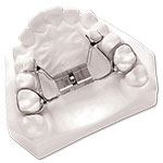 palatal expander model